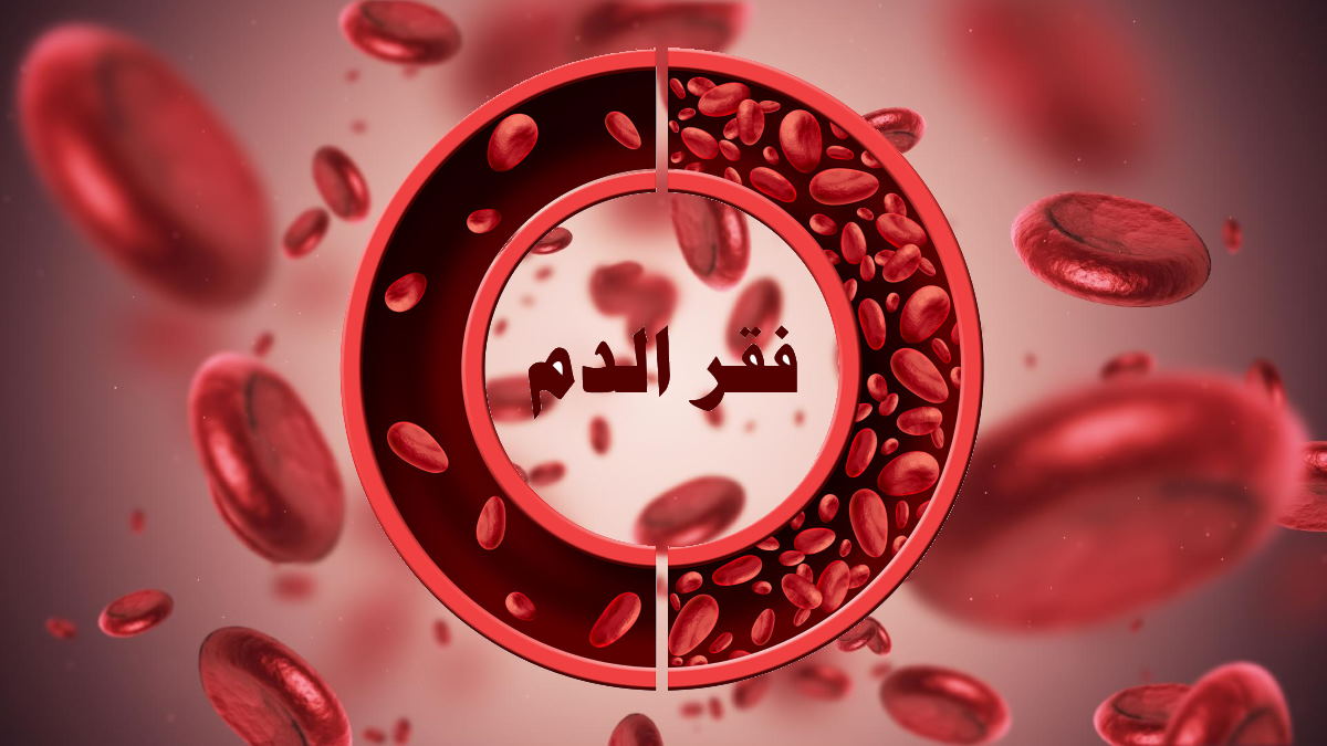 فقر الدم عند الاطفال ( نقص الحديد ) وعلاجه