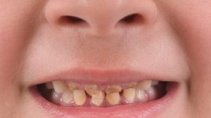 اسباب اصفرار اسنان الاطفال وطرق الوقاية