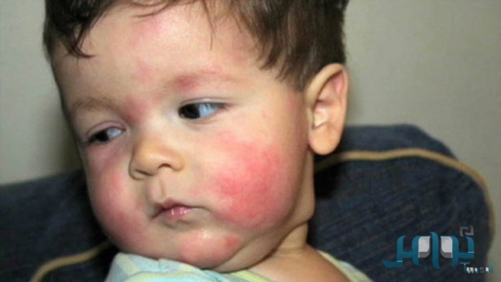 هناك اطعمة تسبب الحساسية للطفل كيف عليك تفاديها