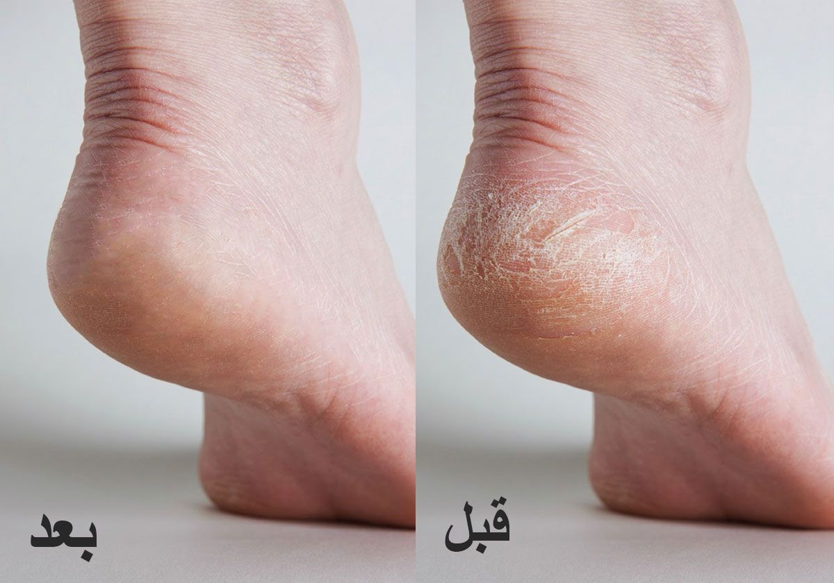 تخلص من تشققات الكعبين بطرق منزلية بسيطة