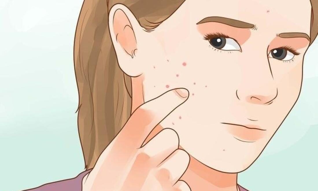بالصور طريقة علاج ااثار حب الشباب
