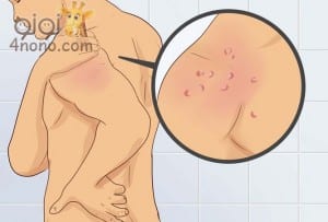 خطوات علاج حروق الشمس في المنزل بالصور