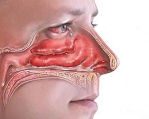 التهاب الانف أعراضه وطرق علاجه