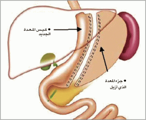 عملية تكميم المعدة وفوائد وأضرارها