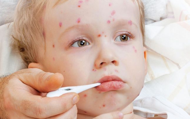 مرض الجدري المائي أعراضة وطرق علاجه