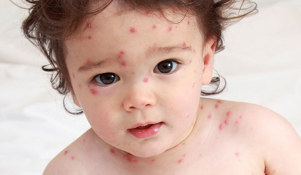 Photo of مرض الجدري المائي أعراضة وطرق علاجه