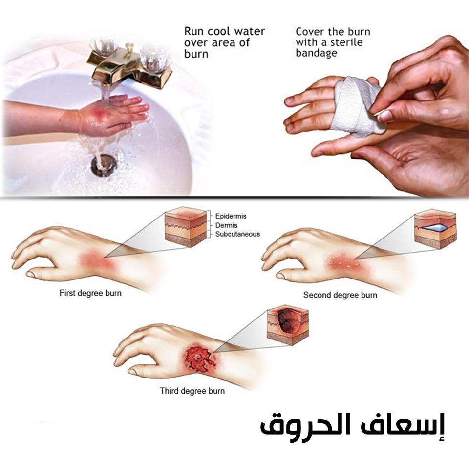 افضل علاج للحروق عند الأطفال