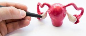 أسباب وأعراض تكيس المبايض وطرق علاجها