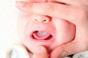 فطريات الفم عند الرضع أسبابها وطرق العلاج