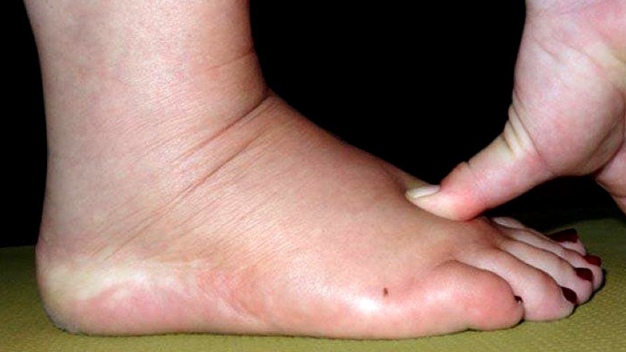 احتباس السوائل عند الحامل وطرق العلاج