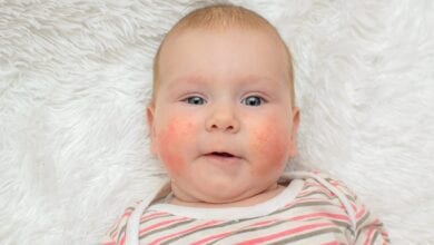 Photo of حساسية عسل النحل عند الأطفال وطرق العلاج
