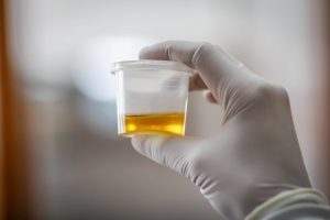 تعرف علي أختلافات لون البول والحالة الصحية