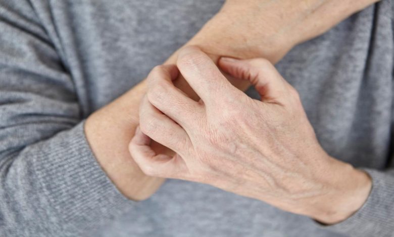 سبب عودة الصدفية بعد شفائها ونصائح هامة لمريض الصدفية