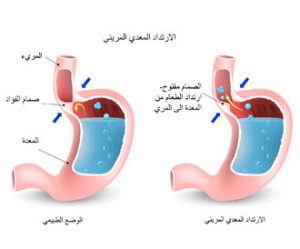 نصائح لحرقة المعدة في الصيام وأطعمة تخلصك من الحموضة