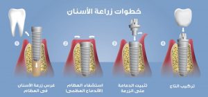 عملية زراعة الاسنان و ما هي مراحل غرس الاسنان
