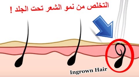طرق التخلص من الشعر تحت الجلد ومنعه من العودة