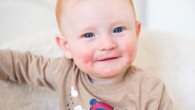 ما هي حساسية الموز؟ وطرق الوقاية منها