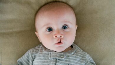 الشفة الارنبية عند الاطفال وعلاجها