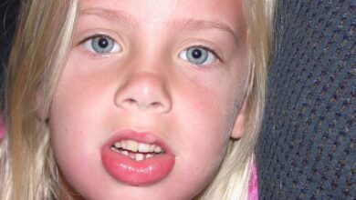 انواع التورمات في الاطفال وكيف تظهر اعراضها وطرق علاجها