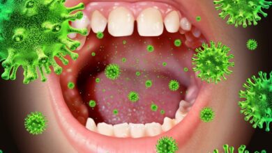 اسباب داء القبلة وعلاجه