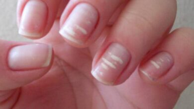 اسباب البقع البيضاء على الاظافر