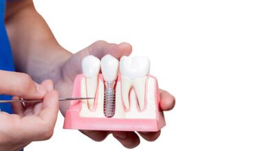 عملية زراعة الاسنان و ما هي مراحل غرس الاسنان