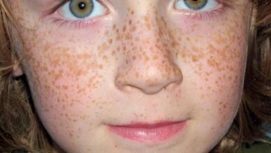 وصفات طبيعية لازالة النمش