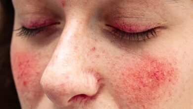 مرض الذئبة الحمراء خطير تعرفي عليه